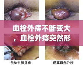血栓外痔不断变大，血栓外痔突然形成 